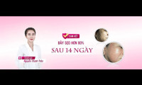 BS Nguyễn Thanh Thảo “Phái đẹp hãy trải nghiệm phương pháp điều trị sẹo, rỗ tại Jenna Thanh”
